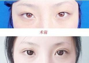 最新割双眼皮手术步骤指南详解