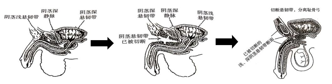 阴茎短小最新治疗方法，重塑自信，重拾男性魅力！